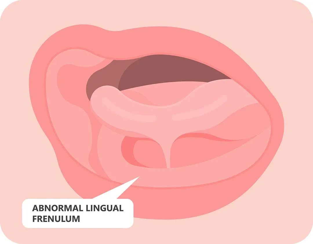 Image of abnormal lingual frenectum