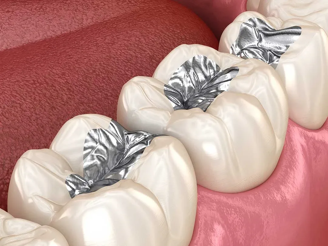 Dental Amalgam: When Is Replacement Necessary?