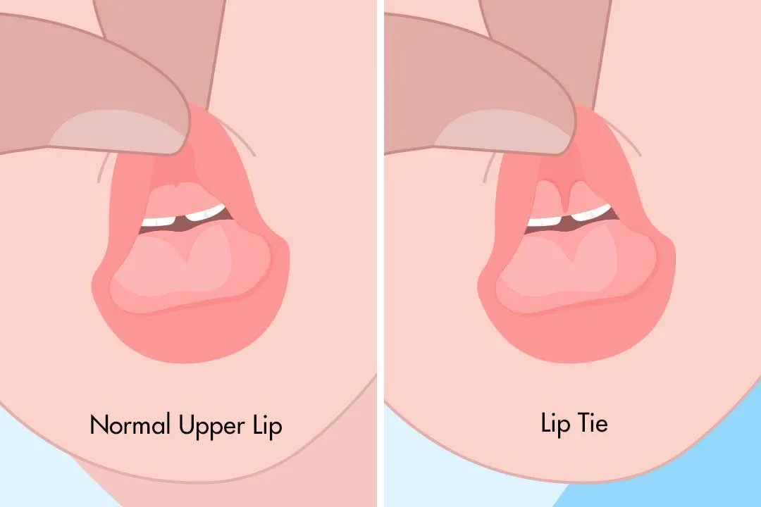 Frenectomy: A Simple Procedure with Big Benefits