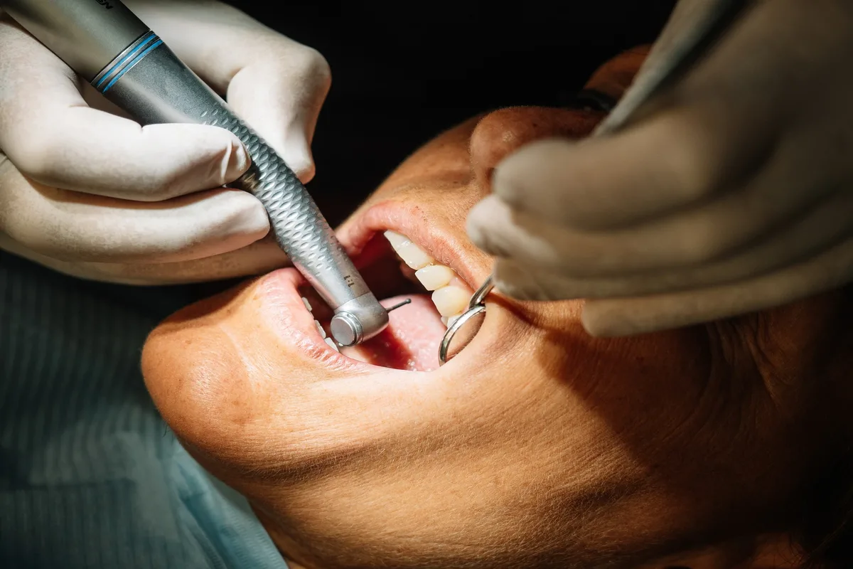 What is Teeth Cleaning: Procedure Steps and Benefits