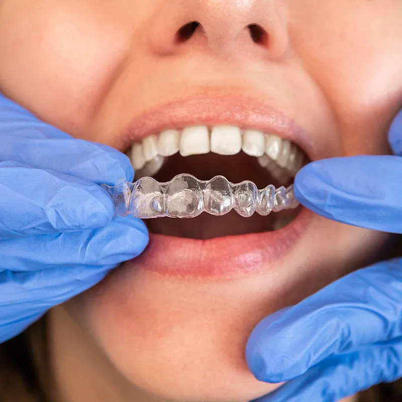 invisalign abu dhabi