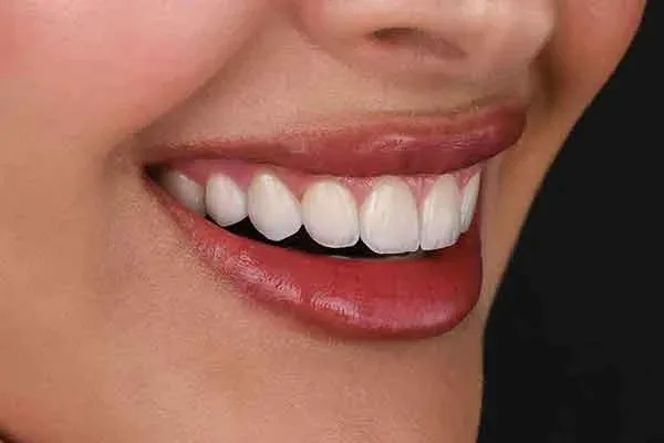 Veneers offer