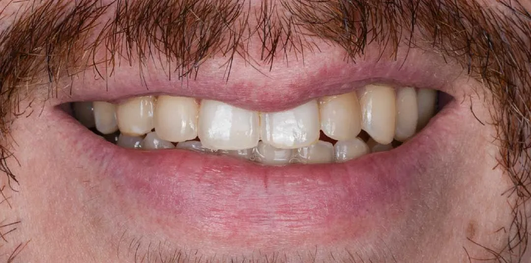 Before in-office teeth whitening treatment