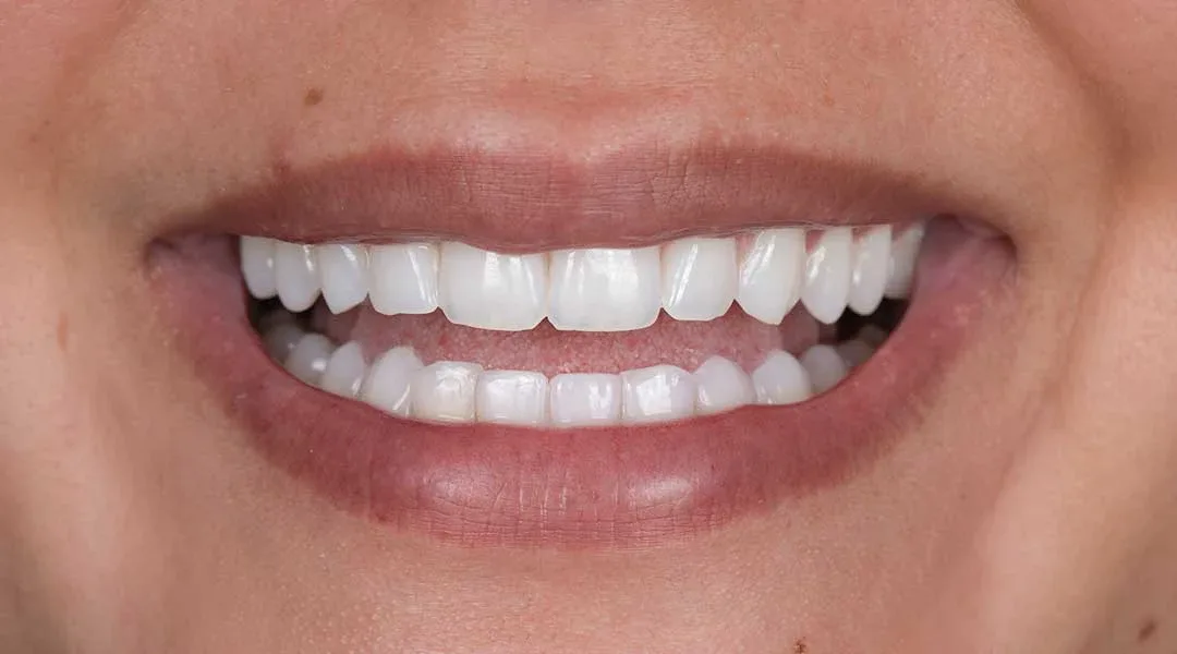 After teeth whitening treatment and Guided Biofilm Therapy at Harmony Medical Center