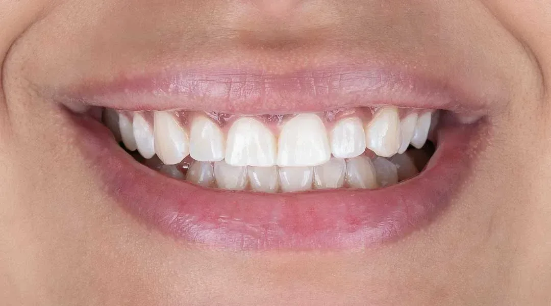 After teeth whitening treatment and Guided Biofilm Therapy at Harmony Medical Center