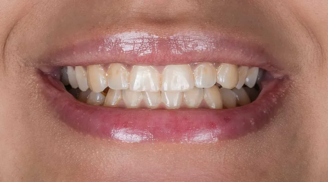 Before teeth whitening treatment and Guided Biofilm Therapy at Harmony Medical Center