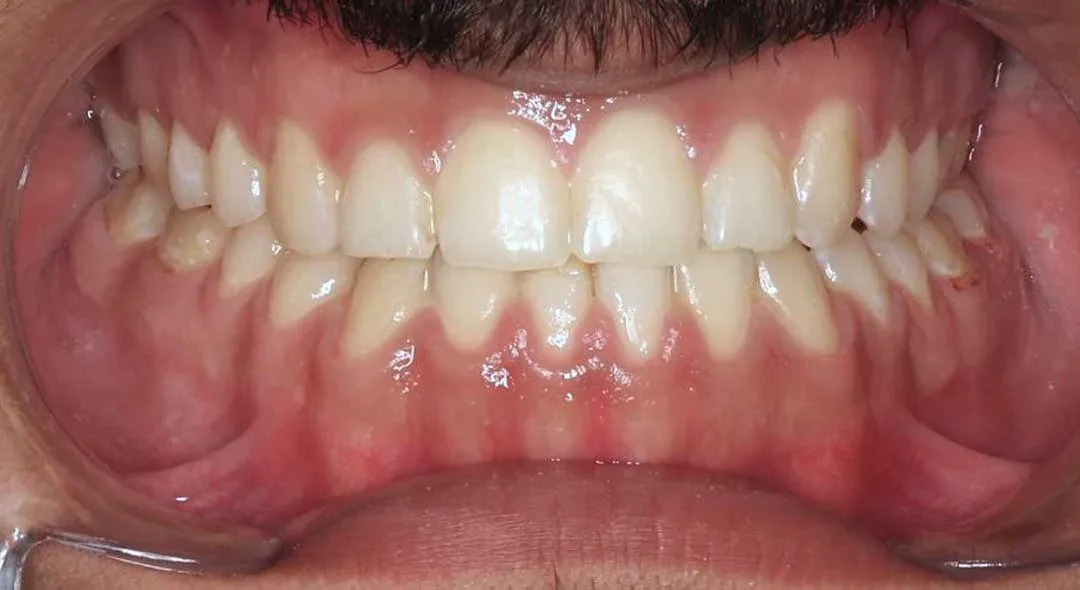 After treatment with braces