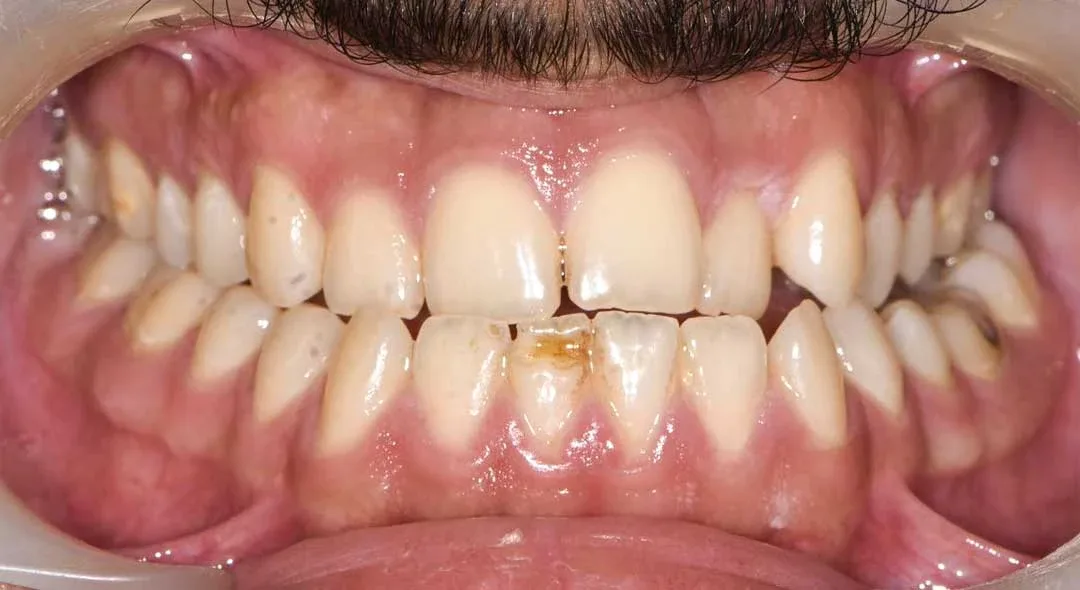 before treatment with braces