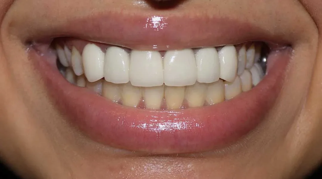 Before Crowns Treatment