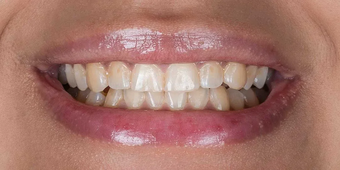 Before Teeth Whitening