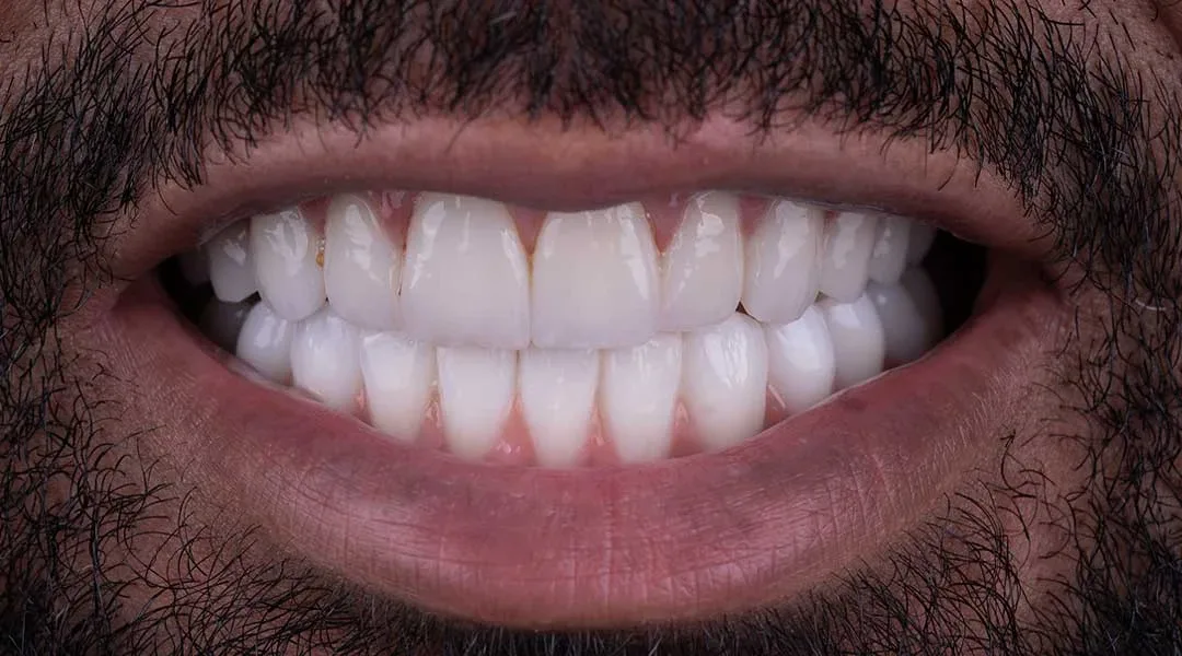 full mouth rehabilitation dubai