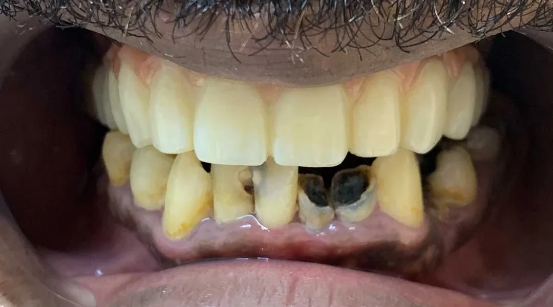 full mouth rehabilitation abu dhabi