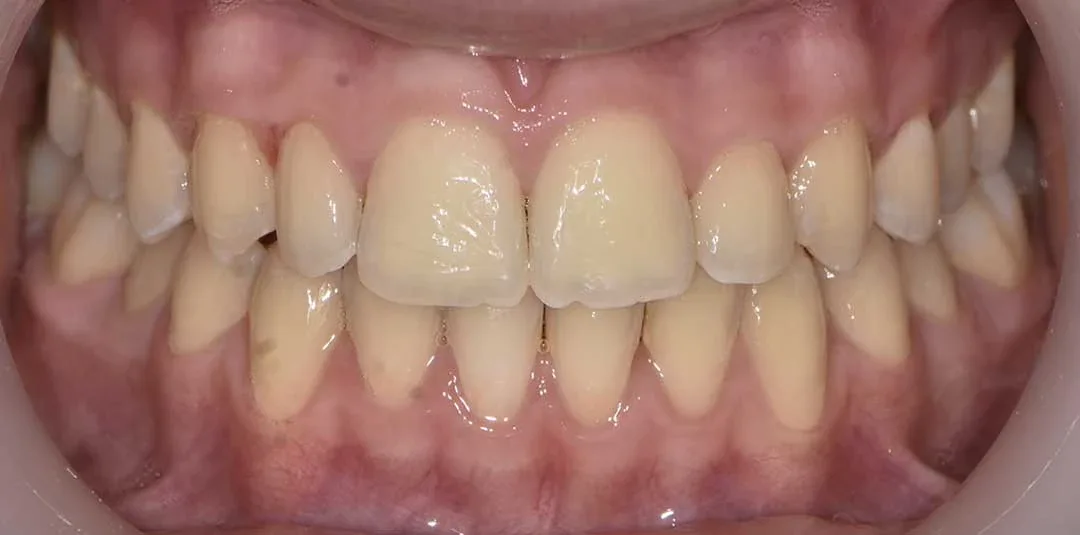 Invisalign dubai