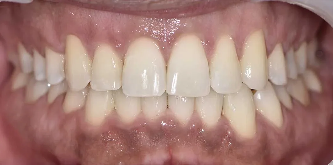 Invisalign Treatment in Dubai