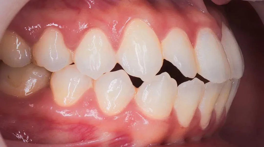Photo showing teeth of a patient before braces treatment with Dr. Karam Kharsa