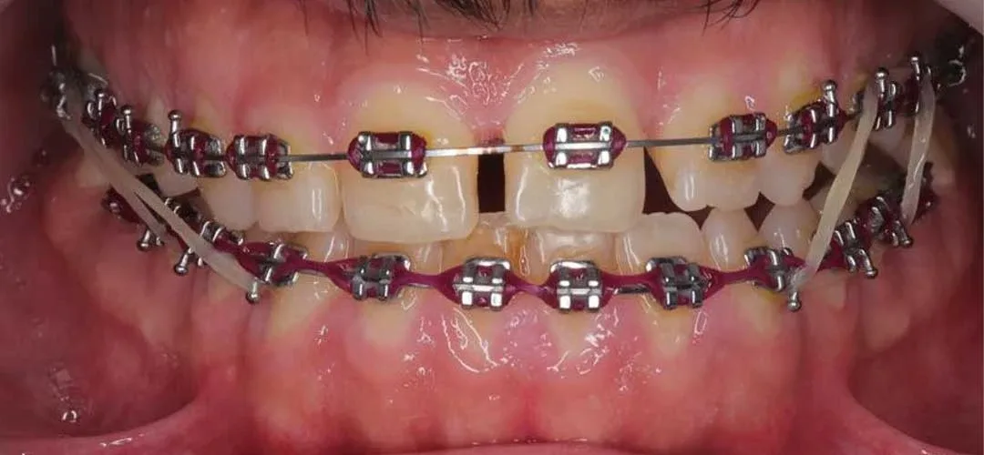 Photo showing teeth of a patient before braces treatment with Dr. Karam Kharsa