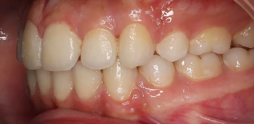 Photo showing teeth of a patient after braces treatment with Dr. Karam Kharsa