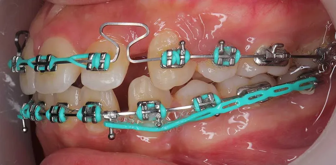 Photo showing teeth of a patient before braces treatment with Dr. Karam Kharsa