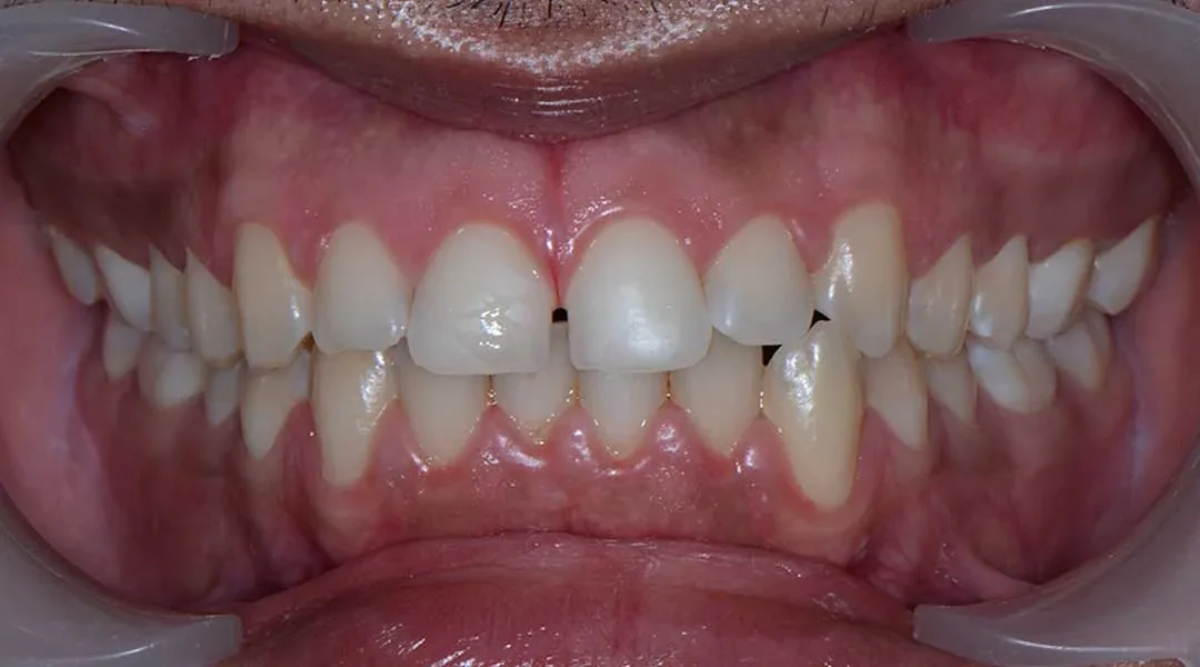 Before Invisalign Treatment