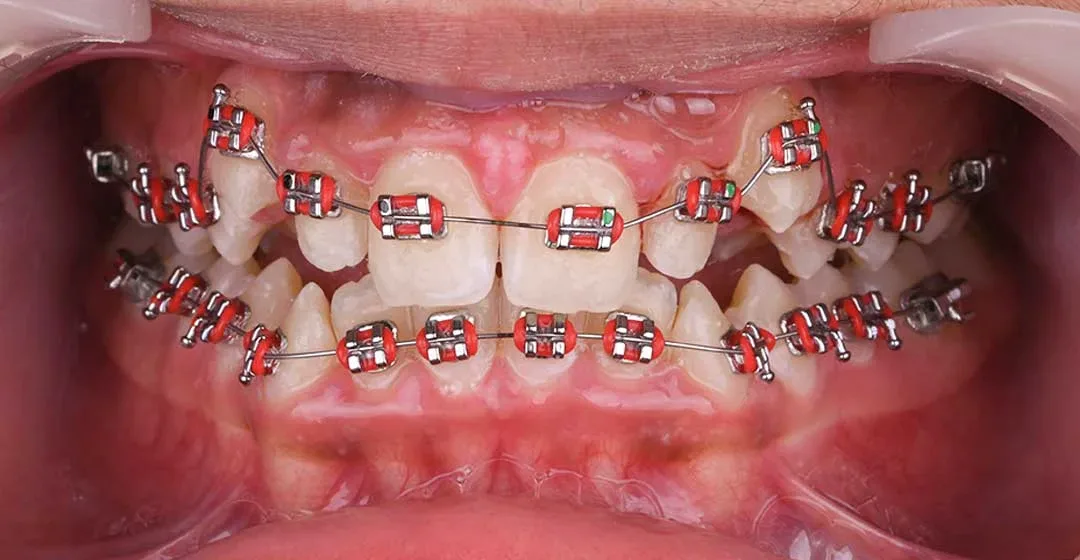 Close-up photo of a patient’s mouth before starting treatment with dental braces at Harmony Medical Center.