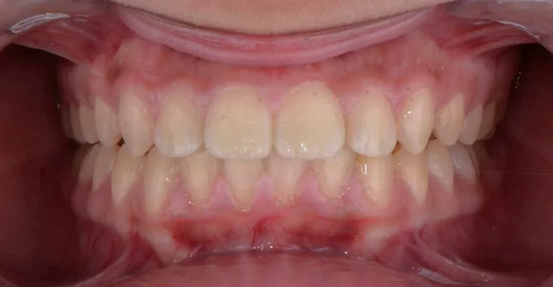After treatment with braces