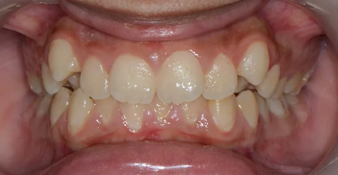 before treatment with braces