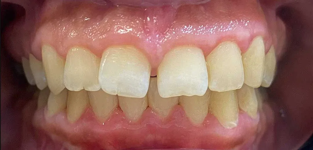 before treatment with braces