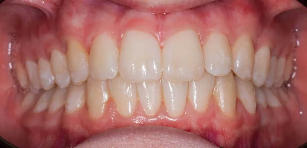 After treatment with braces