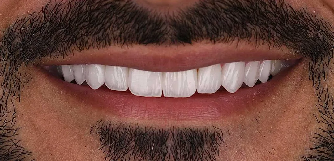 Close-up of a male patient’s new smile refreshed with natural looking and evenly shaped veneers by Dr. Roula Kilani at Harmony Medical Center in Dubai