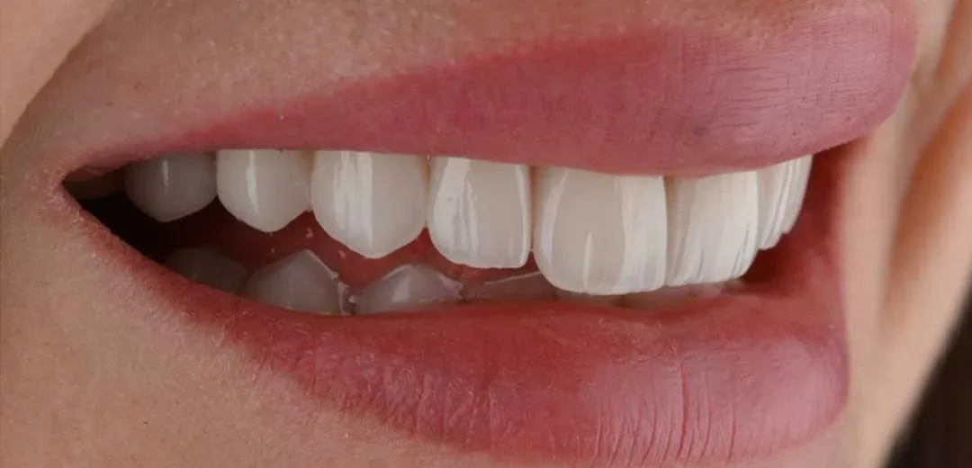 After veneers treatment