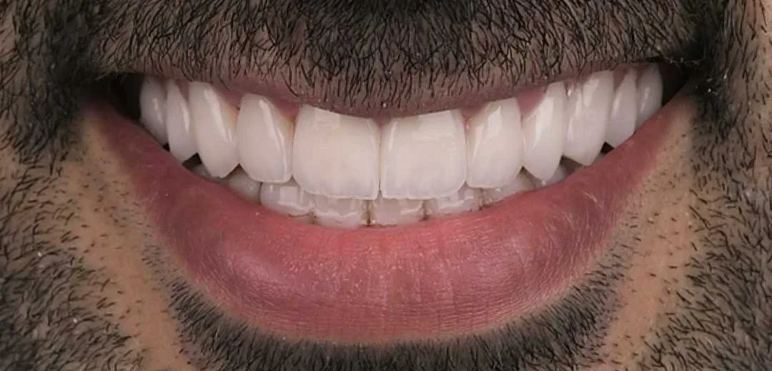 After veneers treatment