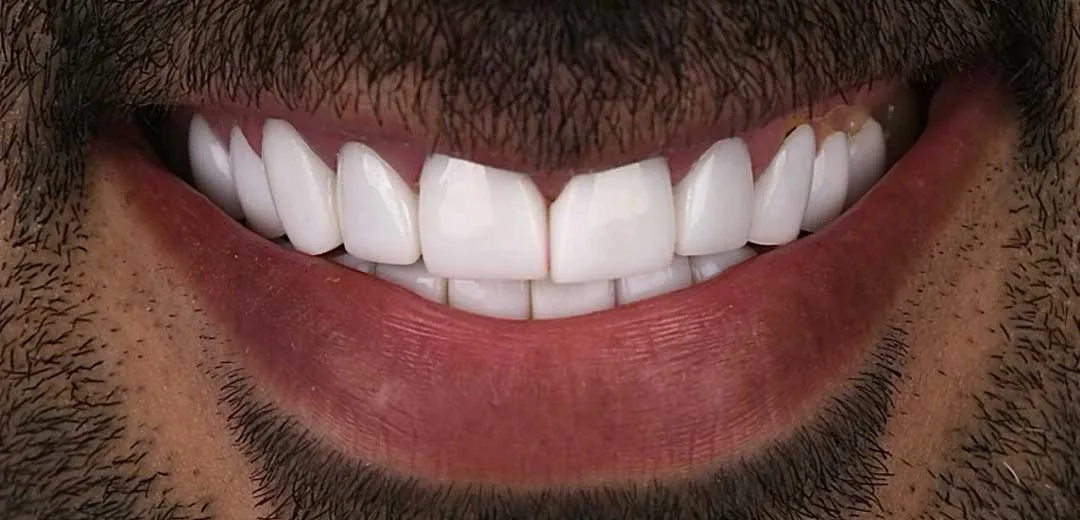 Before veneers treatment