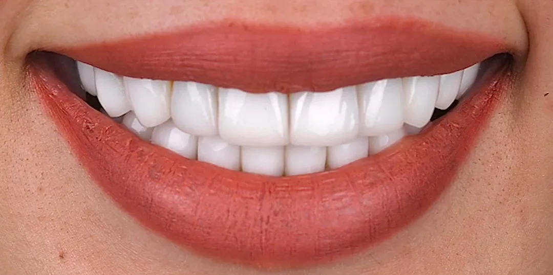 Before veneers treatment