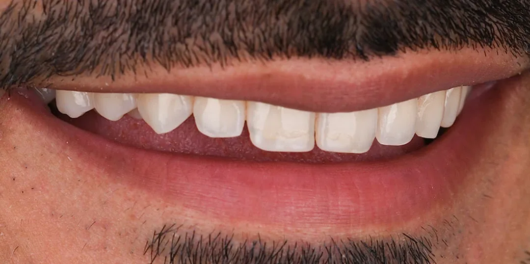 Before veneers treatment