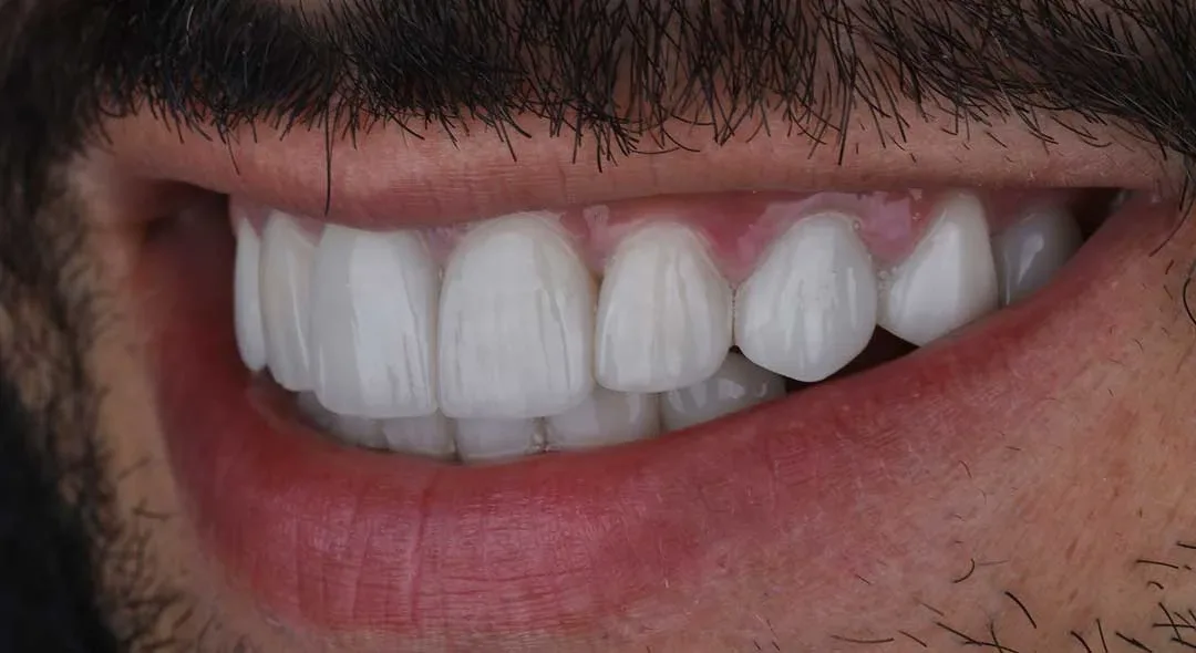 After veneers treatment