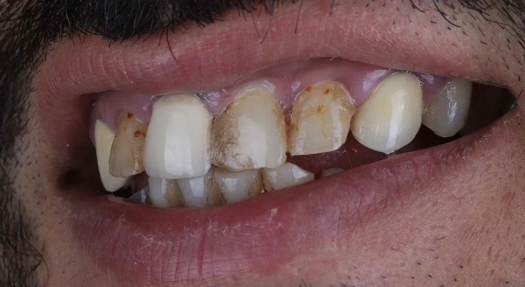 Before veneers treatment