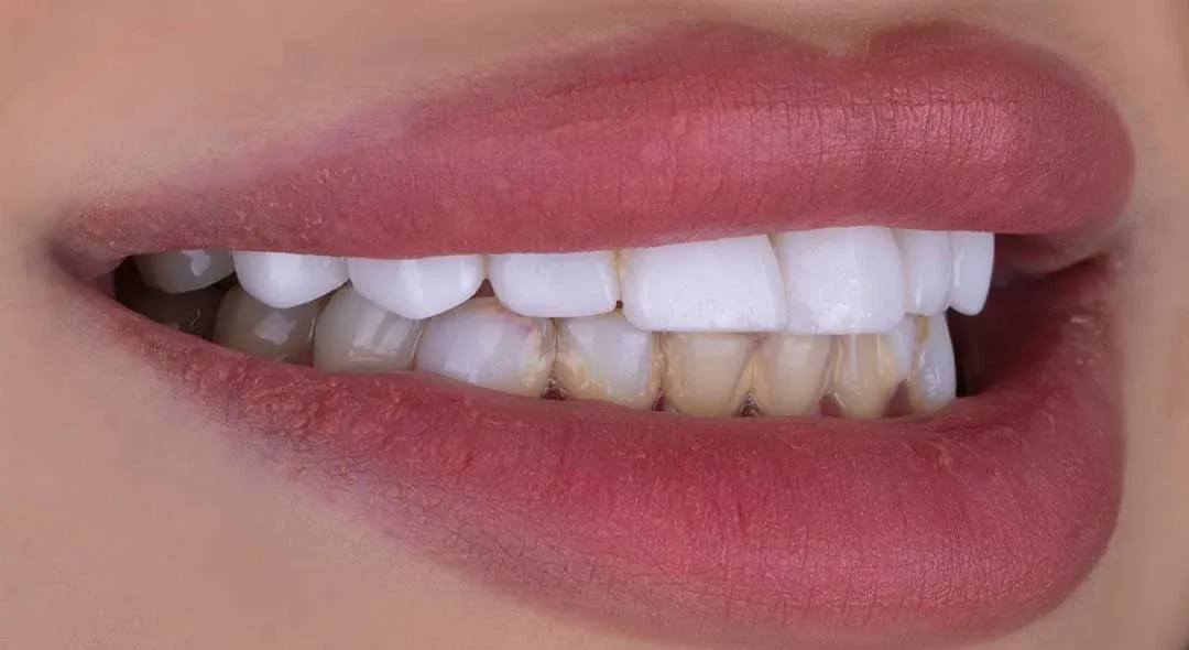 veneers in dubai