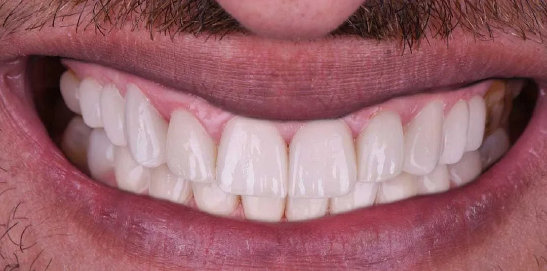 full mouth rehabilitation abu dhabi