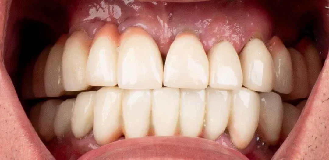 Before dental implants