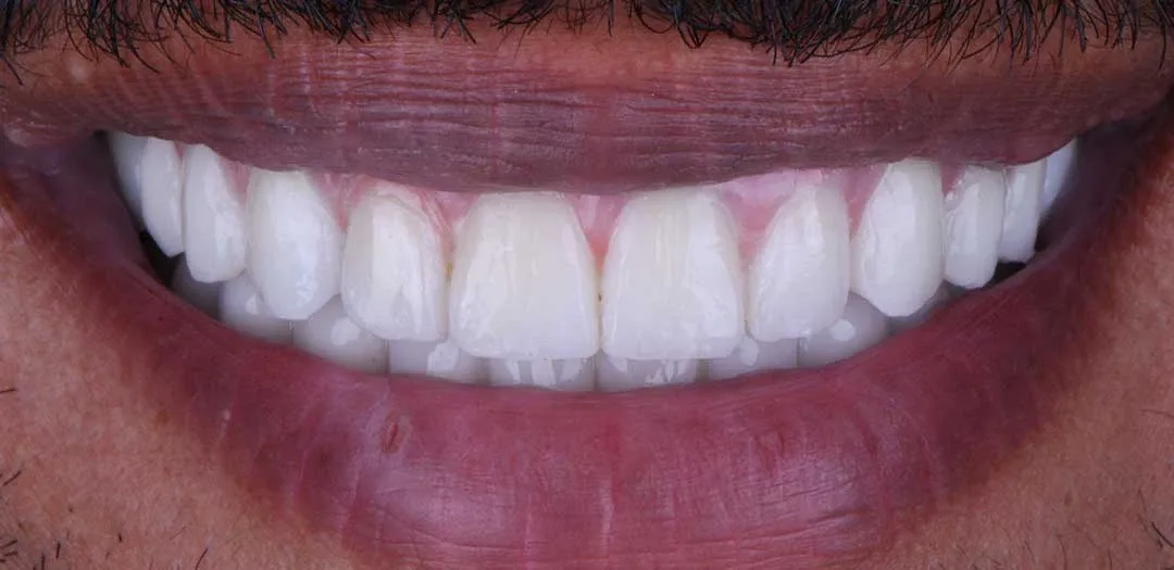After dental implants