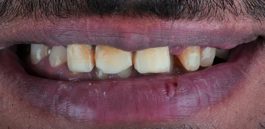 Before dental implants