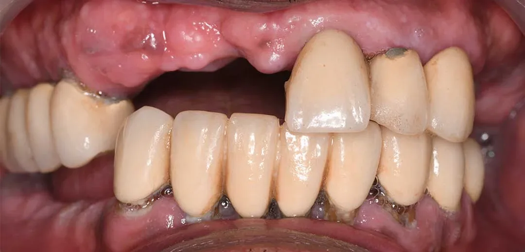 Before dental implants