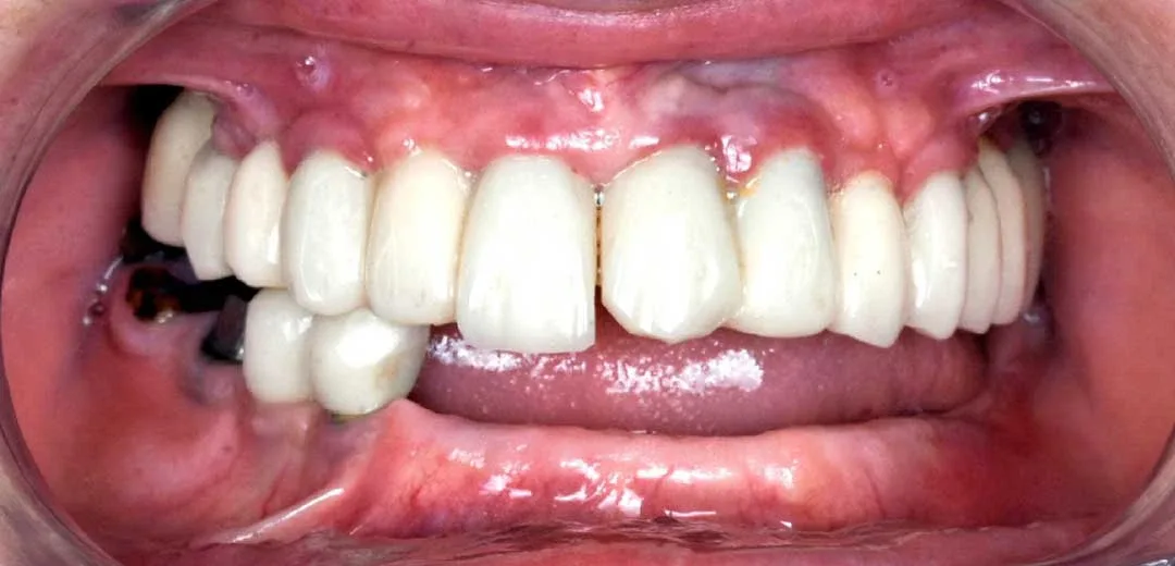 Before dental implants