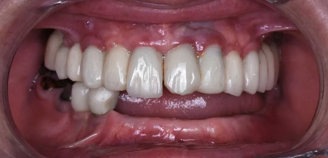 Before dental implants