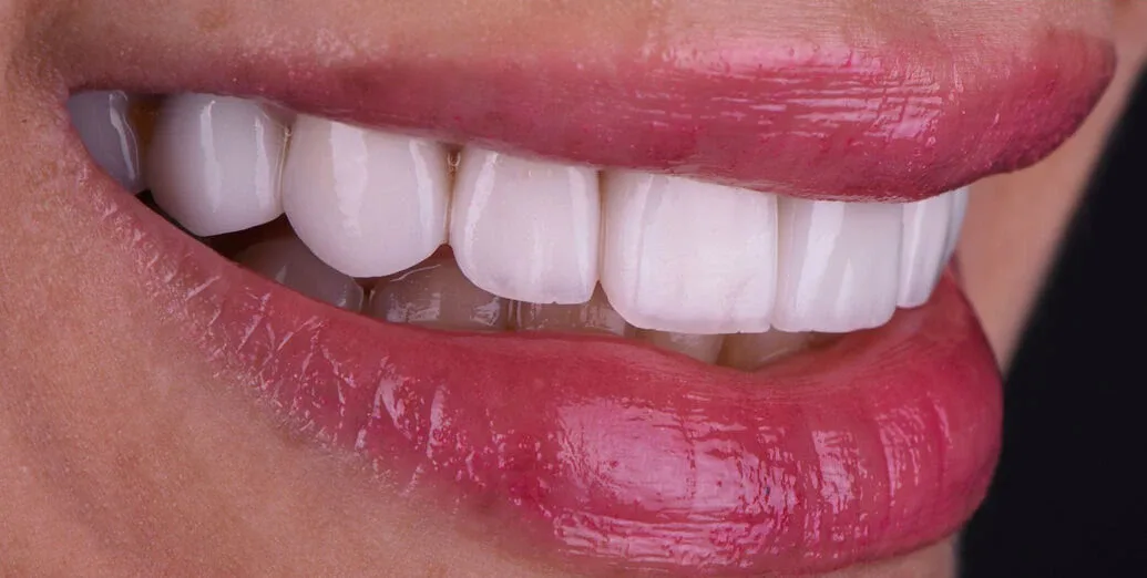 After veneers treatment