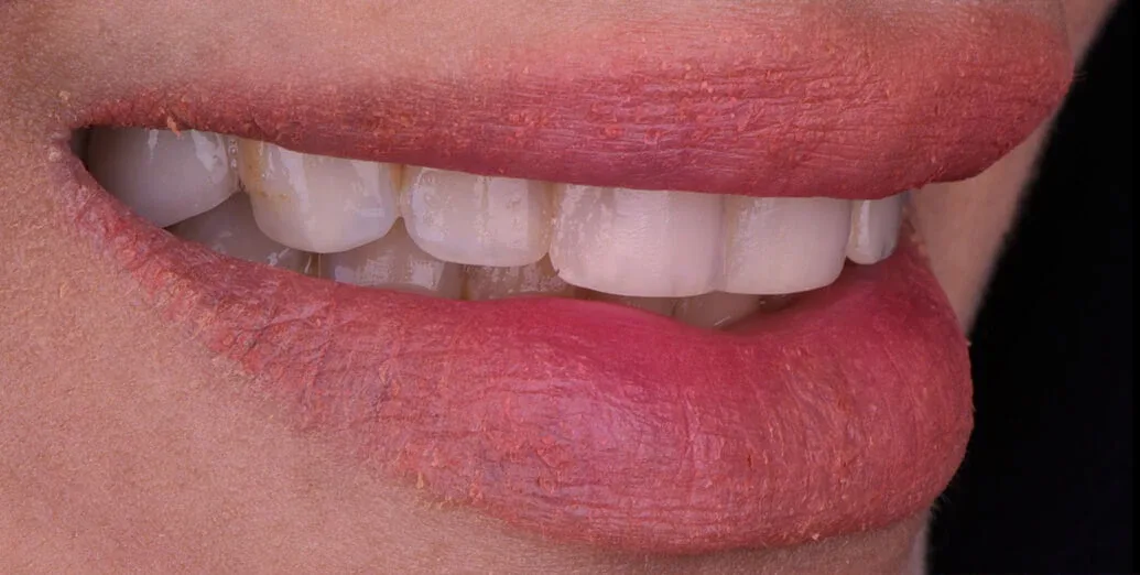 Before veneers treatment