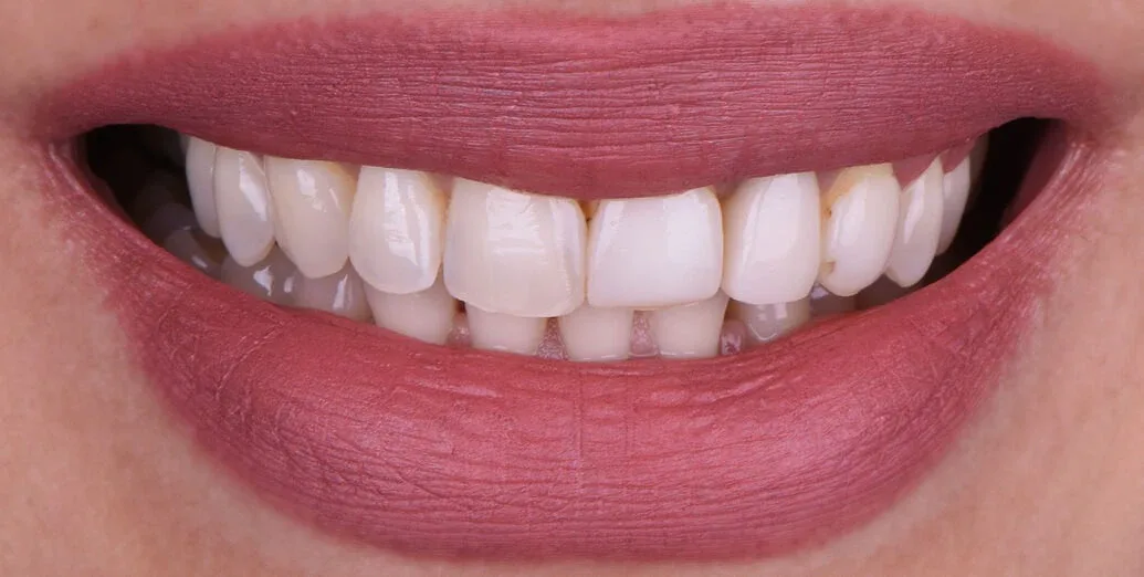 Before veneers treatment