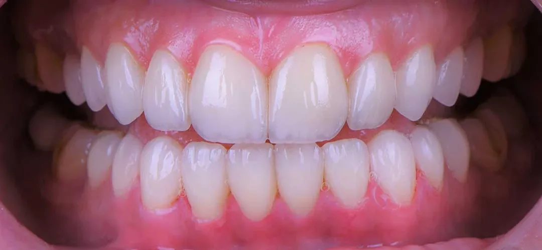 After veneers treatment