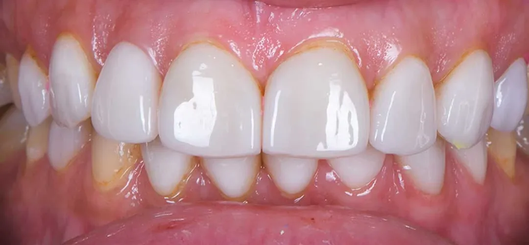 Before veneers treatment