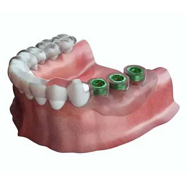 3D-Guided Implant Surgery